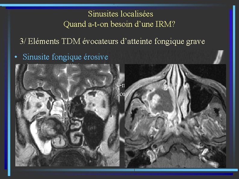  Sinusites localisées Quand a-t-on besoin d’une IRM? 3/ Eléments TDM évocateurs d’atteinte fongique