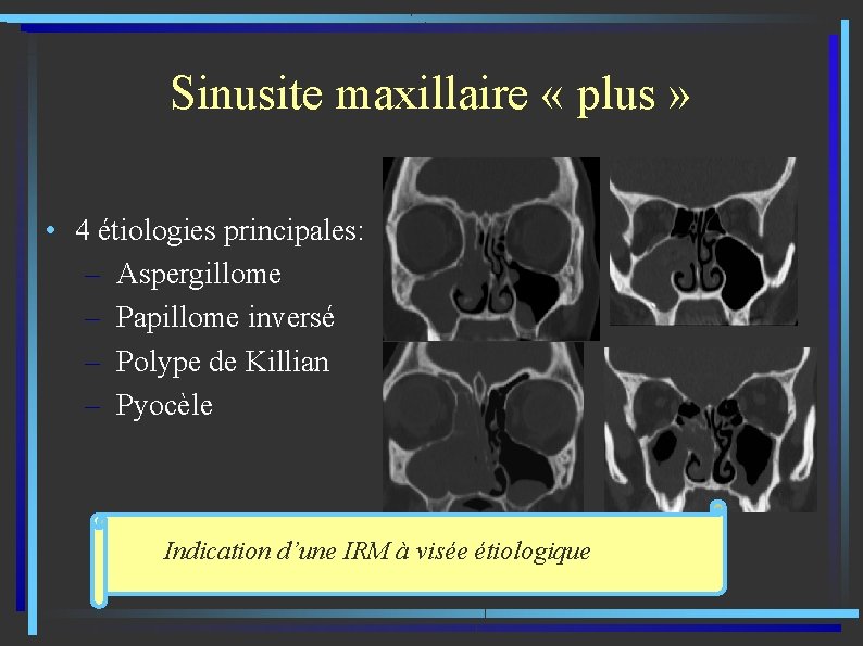 Sinusite maxillaire « plus » • 4 étiologies principales: – Aspergillome – Papillome inversé