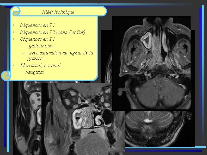 IRM: technique • • Séquences en T 1 Séquences en T 2 (sans Fat