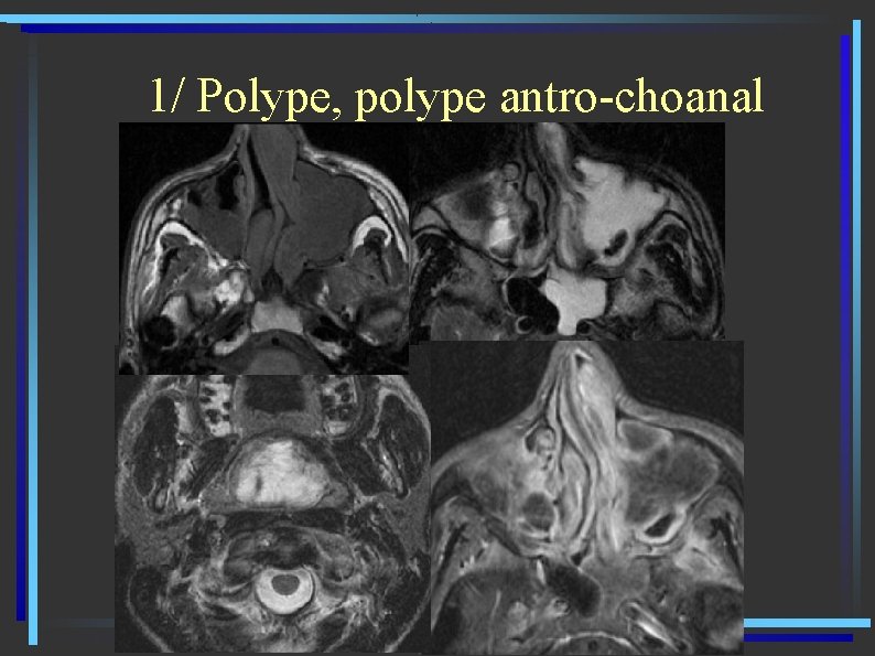 1/ Polype, polype antro-choanal 