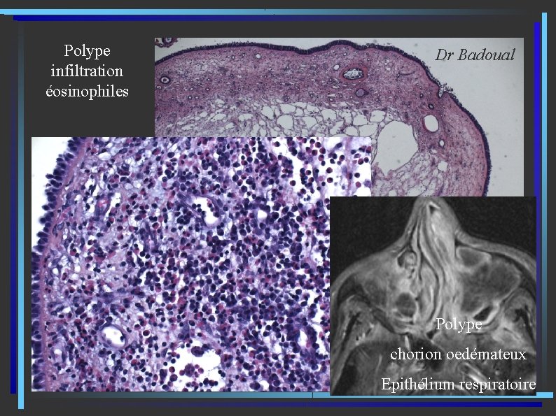 Polype infiltration éosinophiles Dr Badoual Polype chorion oedémateux Polype Epithélium respiratoire 