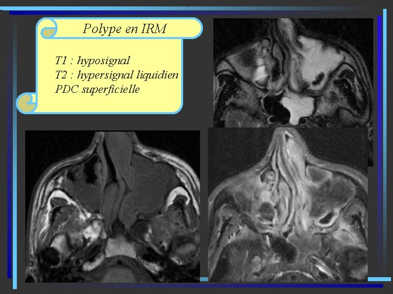 Polype en IRM T 1 : hyposignal T 2 : hypersignal liquidien PDC superficielle