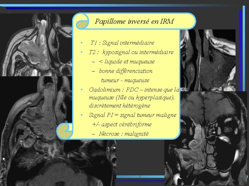  • Papillome inversé en IRM • T 1 : Signal intermédiaire • T