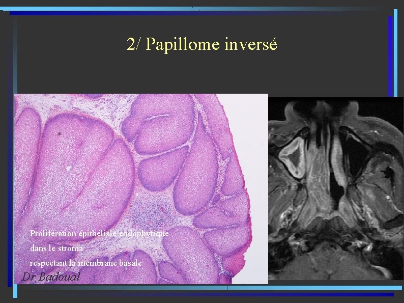 2/ Papillome inversé Prolifération épithéliale endophytique dans le stroma respectant la membrane basale Dr