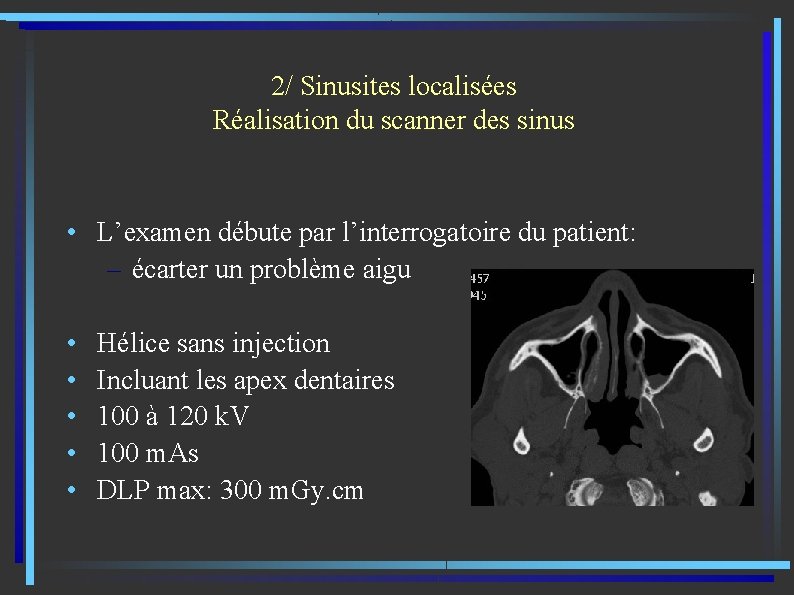 2/ Sinusites localisées Réalisation du scanner des sinus • L’examen débute par l’interrogatoire du