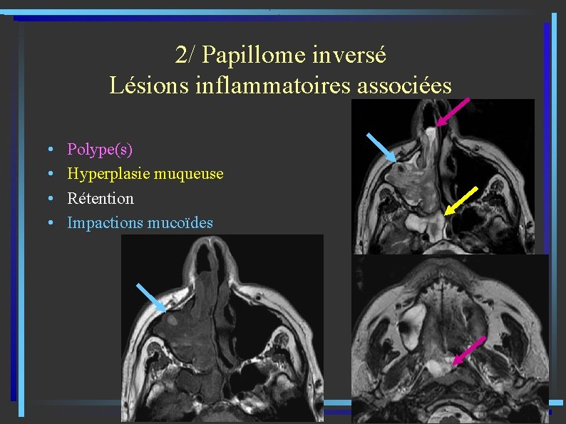 2/ Papillome inversé Lésions inflammatoires associées • • Polype(s) Hyperplasie muqueuse Rétention Impactions mucoïdes