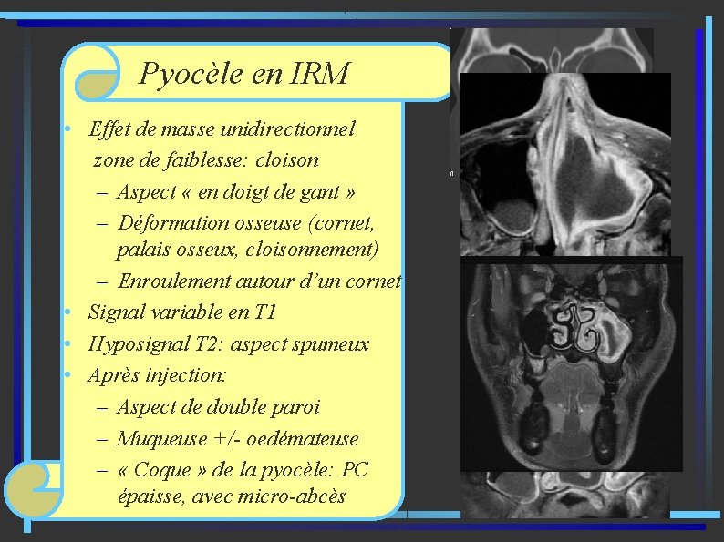 Pyocèle en IRM • Effet de masse unidirectionnel zone de faiblesse: cloison – Aspect