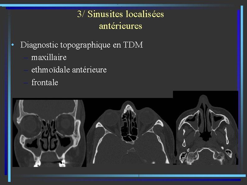 3/ Sinusites localisées antérieures • Diagnostic topographique en TDM – maxillaire – ethmoïdale antérieure