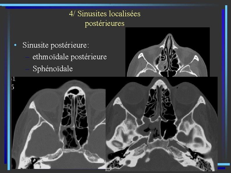 4/ Sinusites localisées postérieures • Sinusite postérieure: – ethmoïdale postérieure – Sphénoïdale 