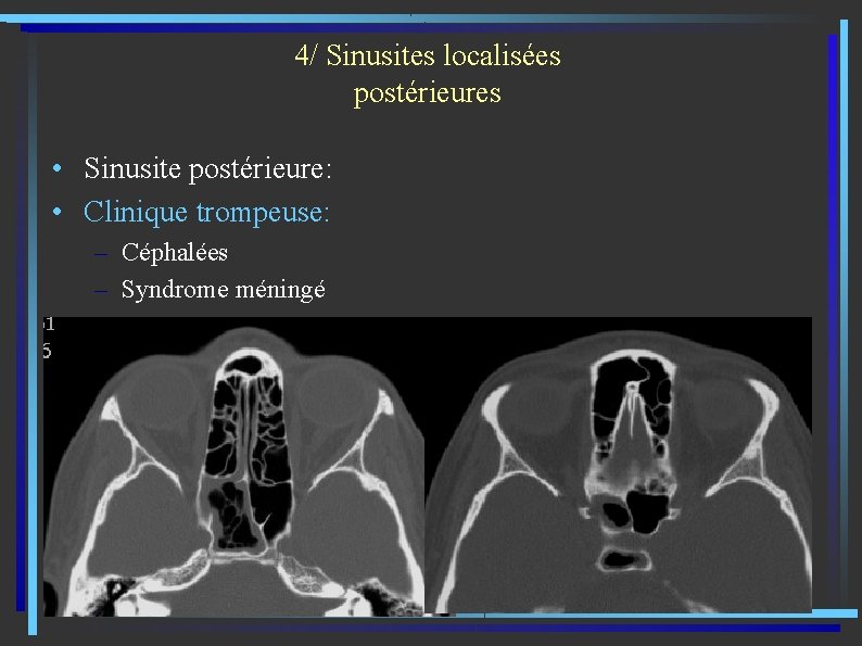 4/ Sinusites localisées postérieures • Sinusite postérieure: • Clinique trompeuse: – Céphalées – Syndrome
