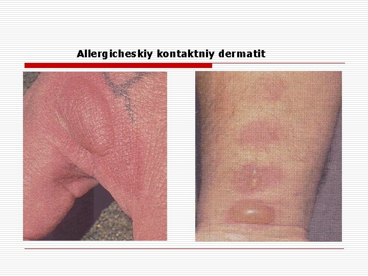  Allergicheskiy kontaktniy dermatit 