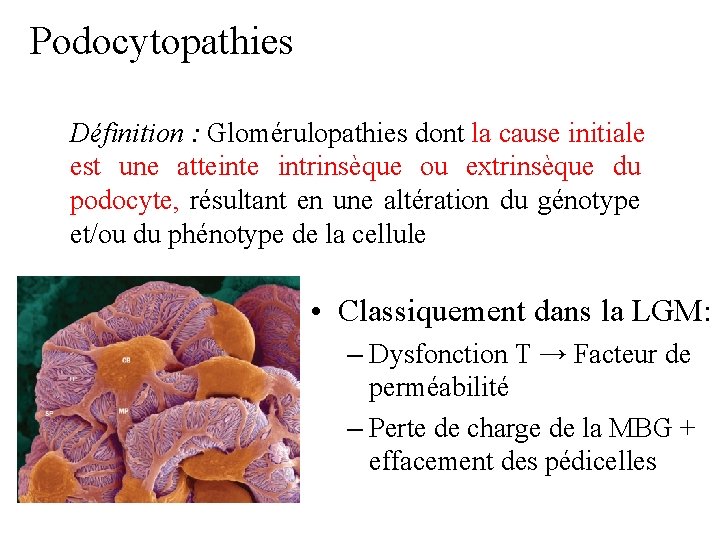 Podocytopathies Définition : Glomérulopathies dont la cause initiale est une atteinte intrinsèque ou extrinsèque Podocytopathies Définition : Glomérulopathies dont la cause initiale est une atteinte intrinsèque ou extrinsèque