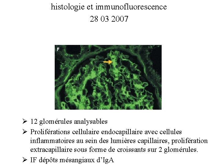histologie et immunofluorescence 28 03 2007 Ø 12 glomérules analysables Ø Proliférations cellulaire endocapillaire histologie et immunofluorescence 28 03 2007 Ø 12 glomérules analysables Ø Proliférations cellulaire endocapillaire