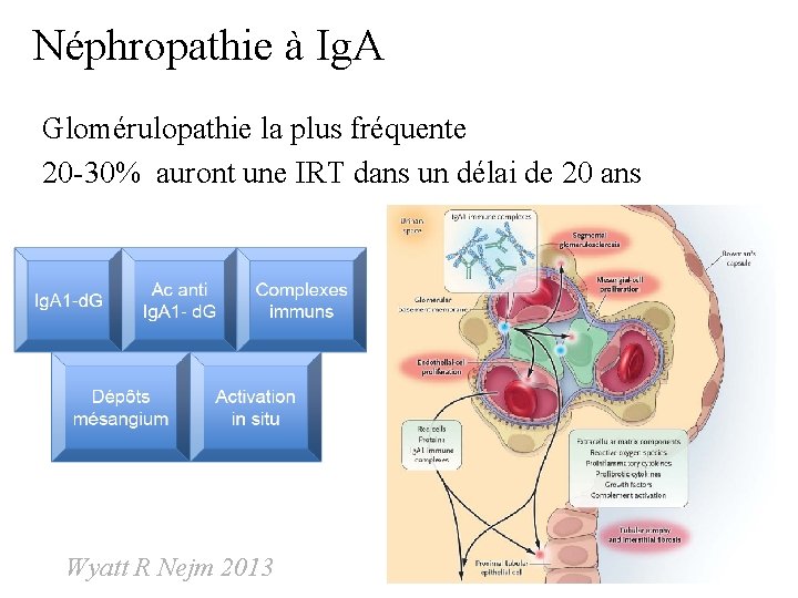 Néphropathie à Ig. A Glomérulopathie la plus fréquente 20 -30% auront une IRT dans Néphropathie à Ig. A Glomérulopathie la plus fréquente 20 -30% auront une IRT dans
