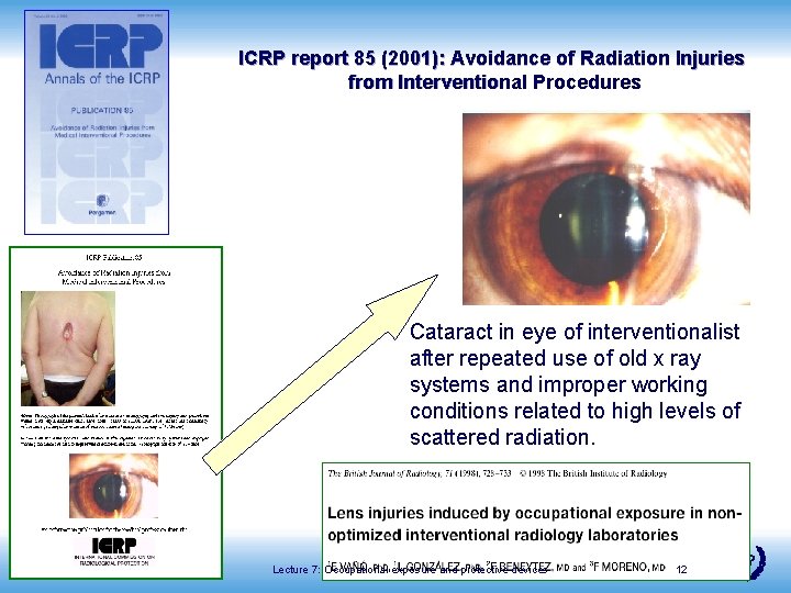 ICRP report 85 (2001): Avoidance of Radiation Injuries from Interventional Procedures Cataract in eye