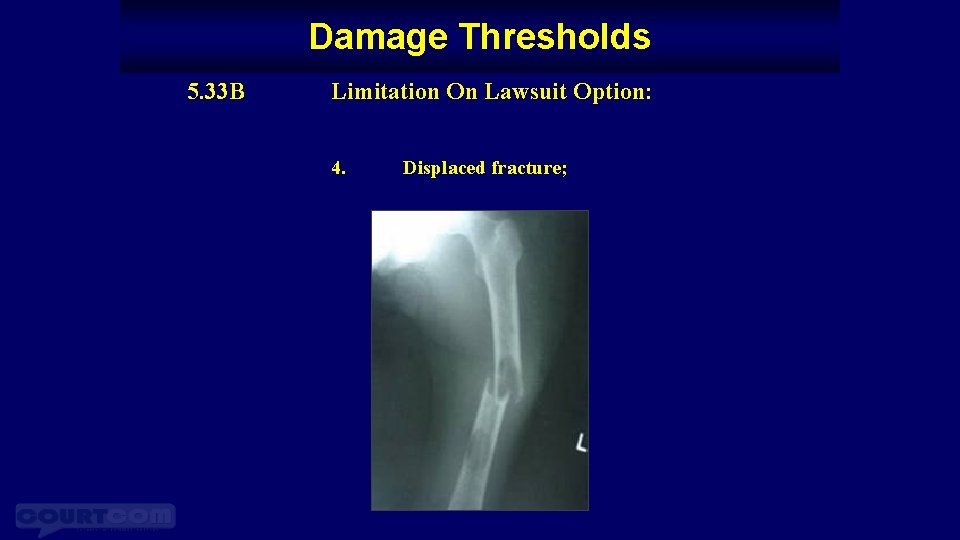 Damage Thresholds 5. 33 B Limitation On Lawsuit Option: 4. Displaced fracture; 