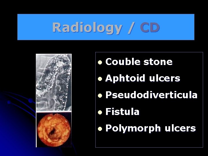 Radiology / CD l Couble stone l Aphtoid ulcers l Pseudodiverticula l Fistula l
