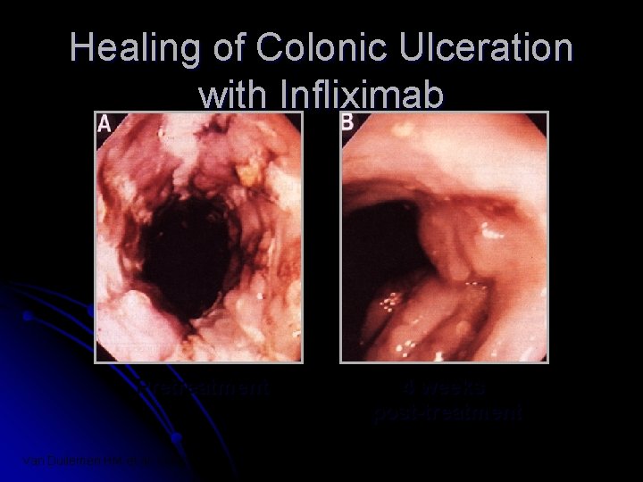 Healing of Colonic Ulceration with Infliximab Pretreatment Van Dullemen HM et al. Gastroenterology 1995;