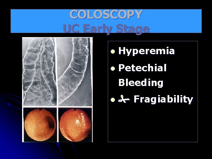 COLOSCOPY UC Early Stage l Hyperemia l Petechial Bleeding l Fragiability 