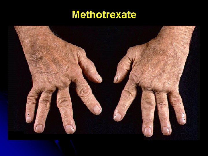 Methotrexate 