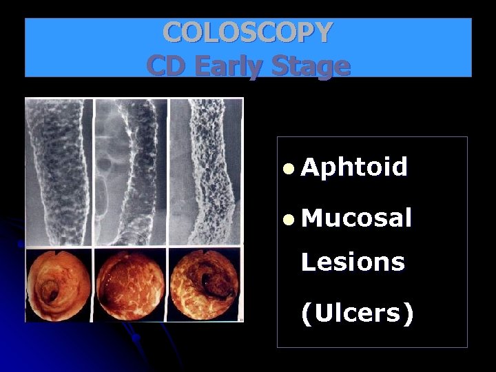 COLOSCOPY CD Early Stage l Aphtoid l Mucosal Lesions (Ulcers) 