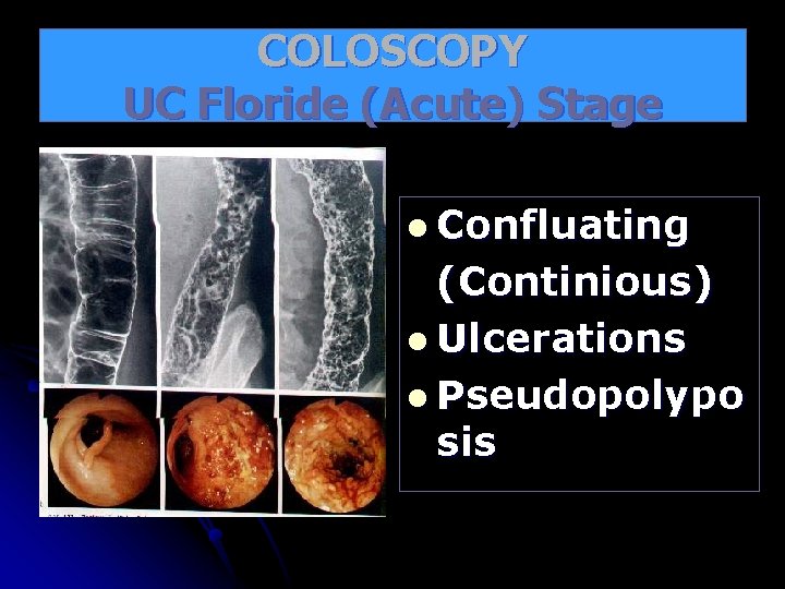 COLOSCOPY UC Floride (Acute) Stage l Confluating (Continious) l Ulcerations l Pseudopolypo sis 