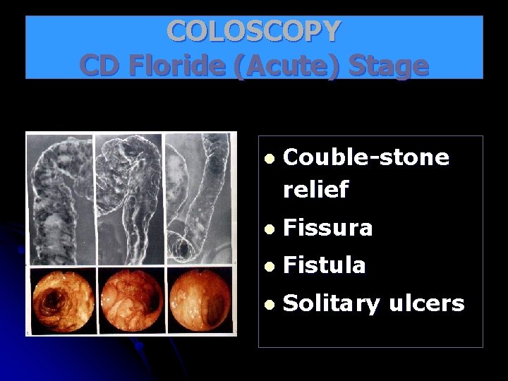 COLOSCOPY CD Floride (Acute) Stage l Couble-stone relief l Fissura l Fistula l Solitary