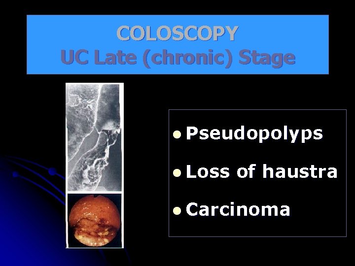 COLOSCOPY UC Late (chronic) Stage l Pseudopolyps l Loss of haustra l Carcinoma 