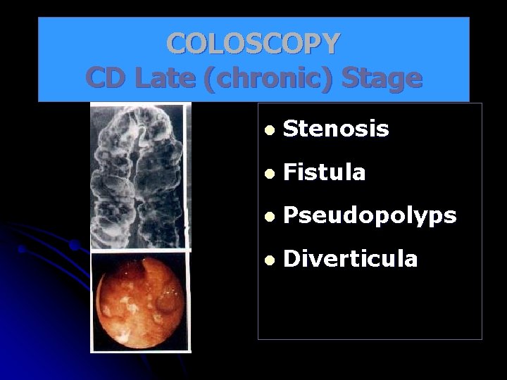 COLOSCOPY CD Late (chronic) Stage l Stenosis l Fistula l Pseudopolyps l Diverticula 