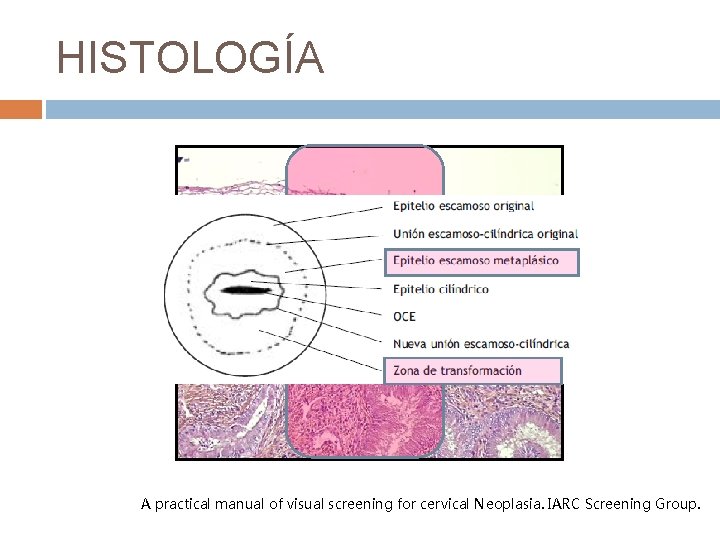 HISTOLOGÍA Escamoso Glandular A practical manual of visual screening for cervical Neoplasia. IARC Screening