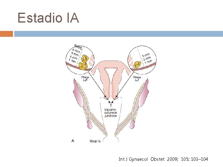 Estadio IA 5 mm International Journal Gynecology and Obstetrics 2009; Int J Gynaecol Obstet