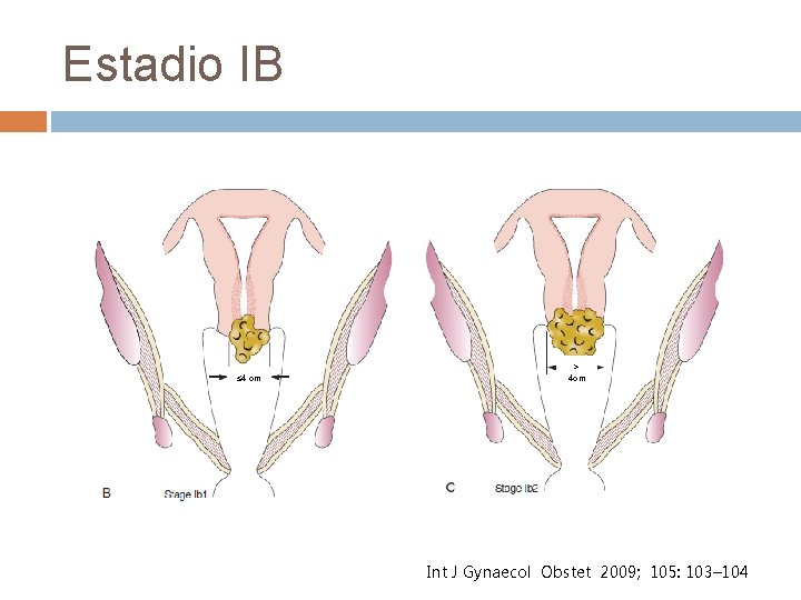 Estadio IB ≤ 4 cm > 4 cm International Obstetrics Int J Gynaecol. Journal