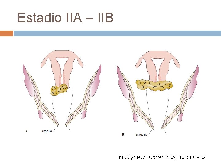 Estadio IIA – IIB International Obstetrics Int J Gynaecol. Journal Obstet. Gynecology 2009; 105: