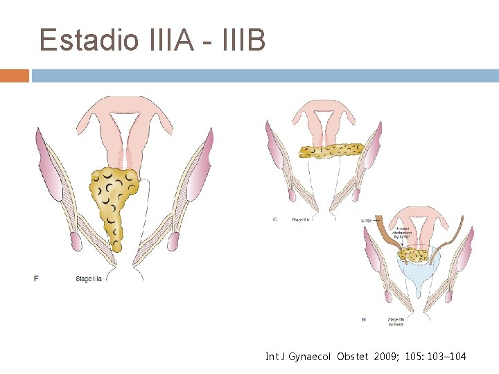 Estadio IIIA - IIIB International Obstetrics Int J Gynaecol. Journal Obstet. Gynecology 2009; 105: