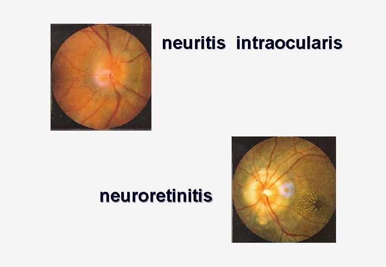 neuritis intraocularis neuroretinitis 