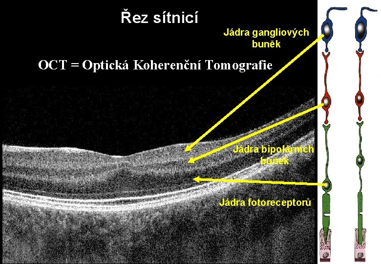 Řez sítnicí Jádra gangliových buněk OCT = Optická Koherenční Tomografie Jádra bipolárních buňek Jádra