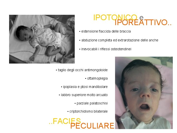 IPOTONICO e IPOREATTIVO. . • estensione flaccida delle braccia • abduzione completa ed extrarotazione