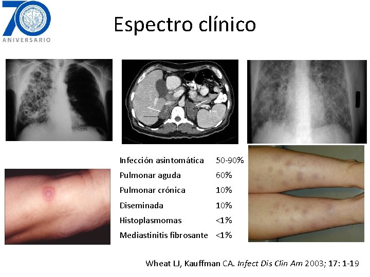 Espectro clínico Infección asintomática 50 -90% Pulmonar aguda 60% Pulmonar crónica 10% Diseminada 10%