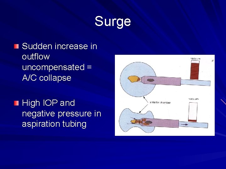 Surge Sudden increase in outflow uncompensated = A/C collapse High IOP and negative pressure
