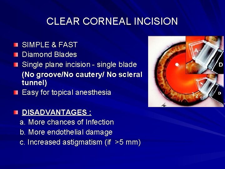 CLEAR CORNEAL INCISION SIMPLE & FAST Diamond Blades Single plane incision - single blade
