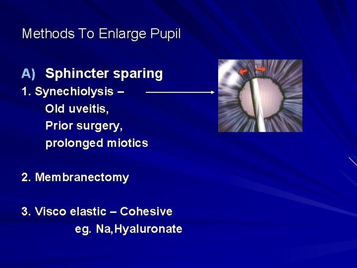 Methods To Enlarge Pupil A) Sphincter sparing 1. Synechiolysis – Old uveitis, Prior surgery,