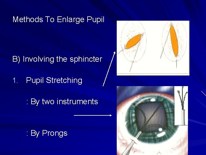 Methods To Enlarge Pupil B) Involving the sphincter 1. Pupil Stretching : By two