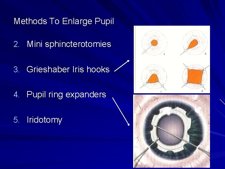 Methods To Enlarge Pupil 2. Mini sphincterotomies 3. Grieshaber Iris hooks 4. Pupil ring