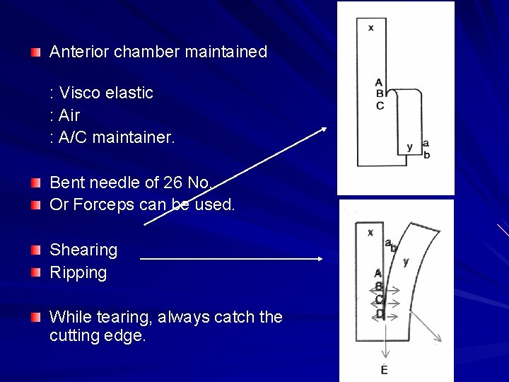 Anterior chamber maintained : Visco elastic : Air : A/C maintainer. Bent needle of