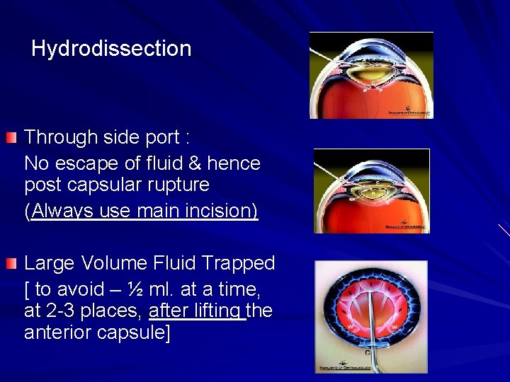 Hydrodissection Through side port : No escape of fluid & hence post capsular rupture