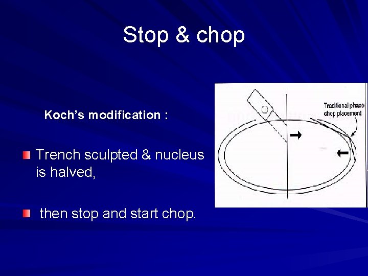 Stop & chop Koch’s modification : Trench sculpted & nucleus is halved, then stop
