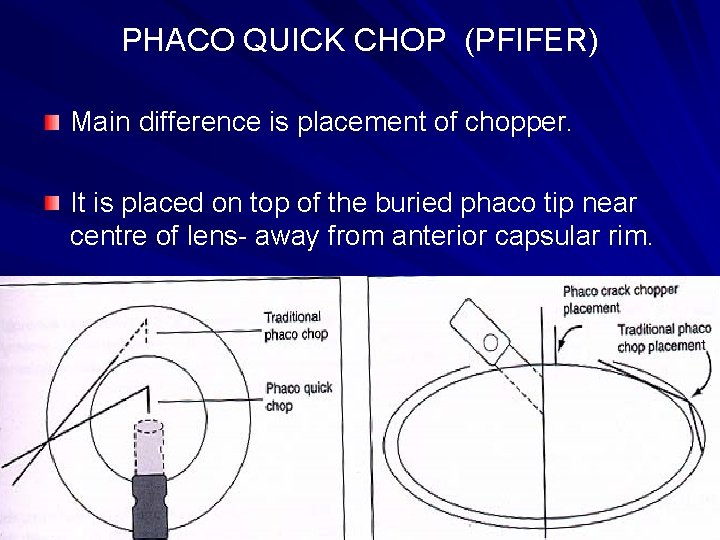 PHACO QUICK CHOP (PFIFER) Main difference is placement of chopper. It is placed on