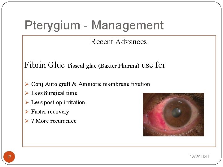 Pterygium - Management Recent Advances Fibrin Glue Tisseal glue (Baxter Pharma) use for Ø