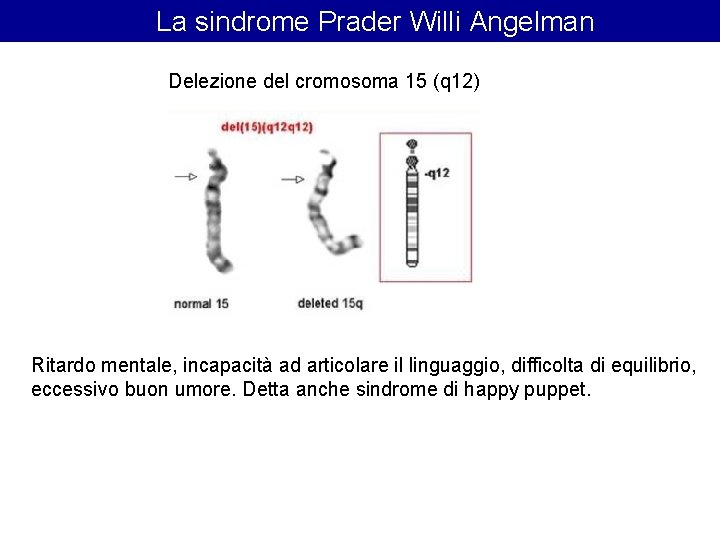 La sindrome Prader Willi Angelman Delezione del cromosoma 15 (q 12) Ritardo mentale, La sindrome Prader Willi Angelman Delezione del cromosoma 15 (q 12) Ritardo mentale,