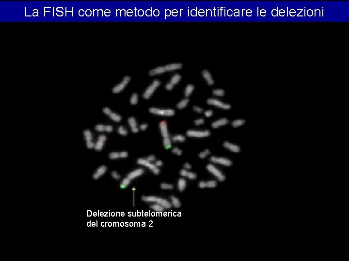 La FISH come metodo per identificare le delezioni Delezione subtelomerica del cromosoma 2: La FISH come metodo per identificare le delezioni Delezione subtelomerica del cromosoma 2: